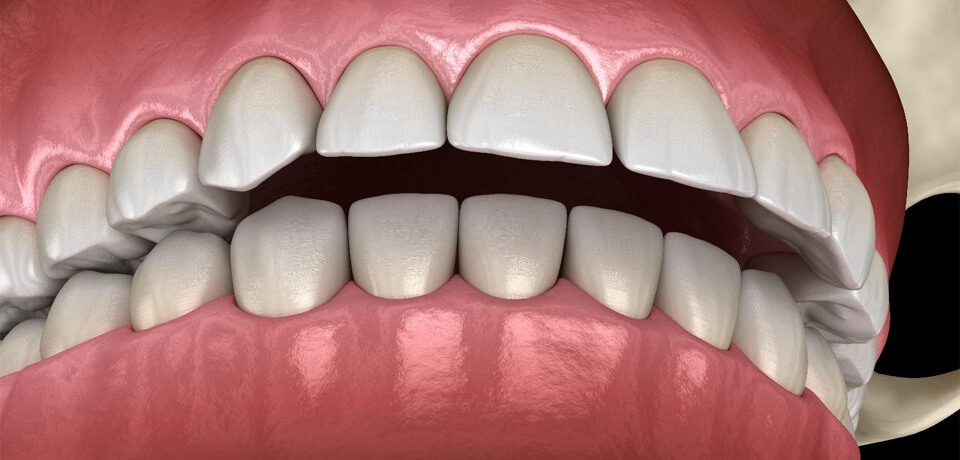 All About Overbite Teeth and How to Fix it?